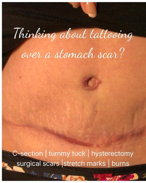 Stomach scar tattoo by @joharrison_tattoo