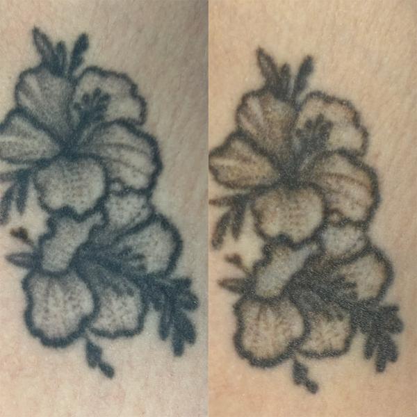Blackwork floral design tattoo by @traceless.laser